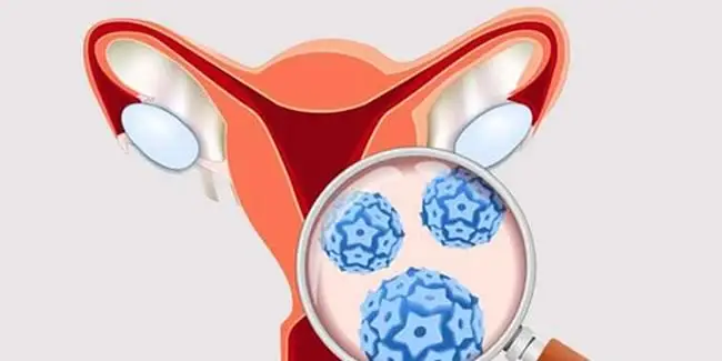 cervicalcancer